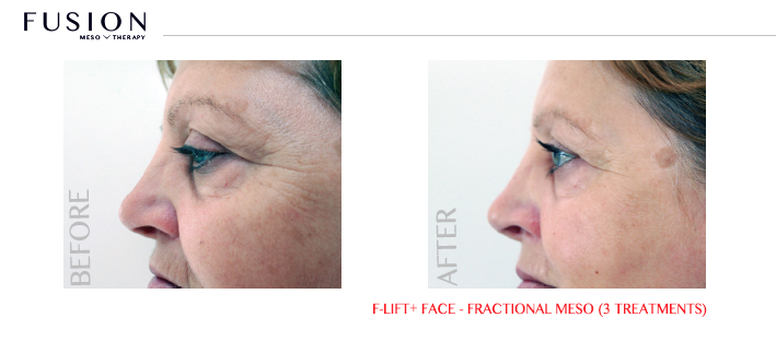 Fusion-BA-F-LiftFace-Fractional-Meso-3-treatments.jpg