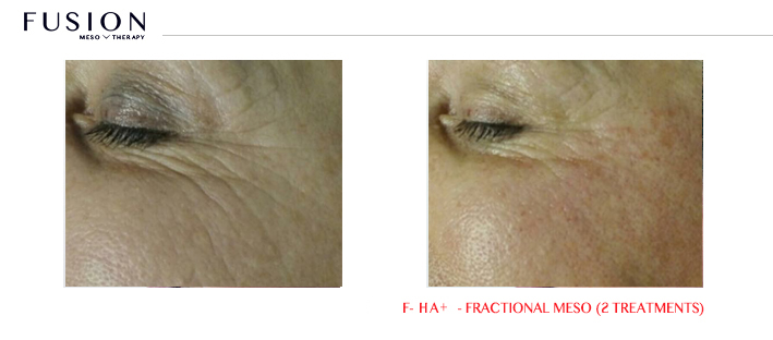 Fusion-BA-HA-Fractional-Meso-2-treatments.jpg