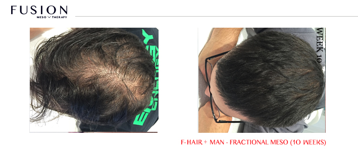 Fusion-BA-HAIR-MAN-Fractional-Meso-10-weeks.jpg