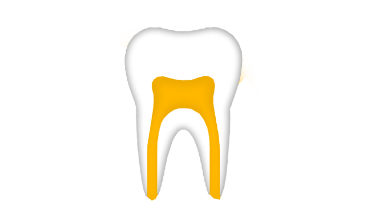 Root Canals