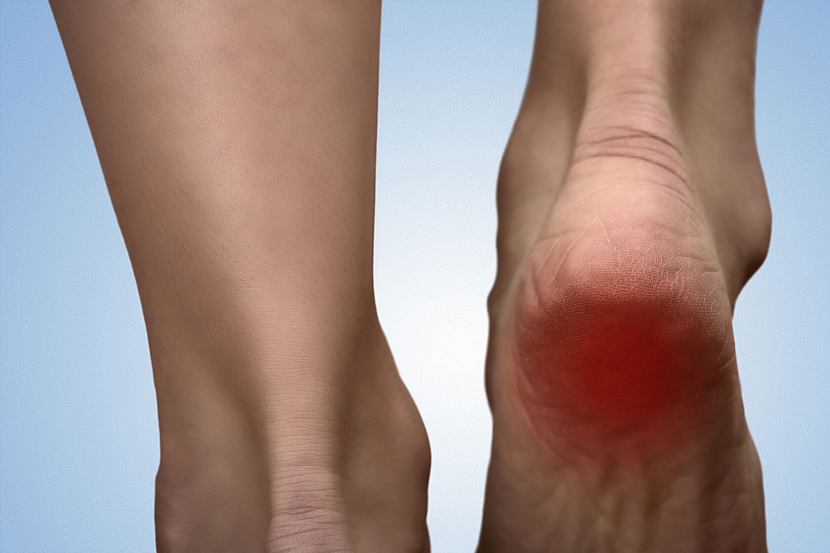 Heel Spurs Treatment in Miami | Barry M. Tuvel, DPM