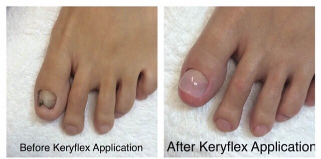 Nail Fungus & Nail Restoration Specialists in Annapolis, MD — Podiatry  Group of Annapolis, .