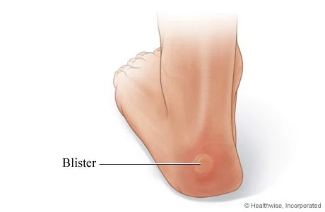 Blisters on the Feet  
