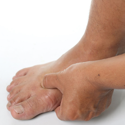 Quick Facts on Hallux Rigidus or Big Toe Arthritis