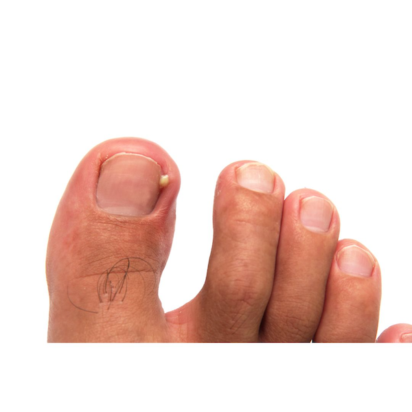 Ingrown Toenails 