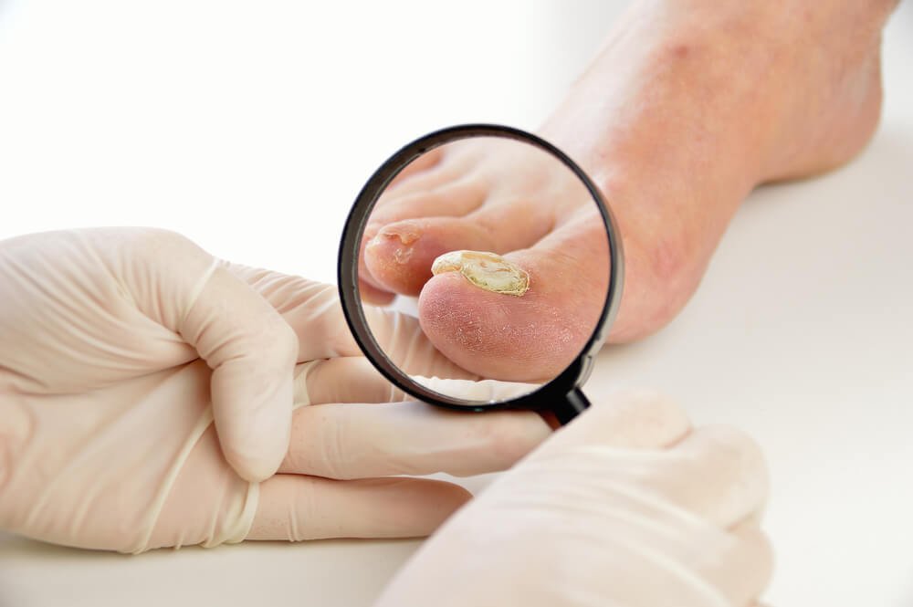 A New FDA Approved Treatment for Nail Fungus