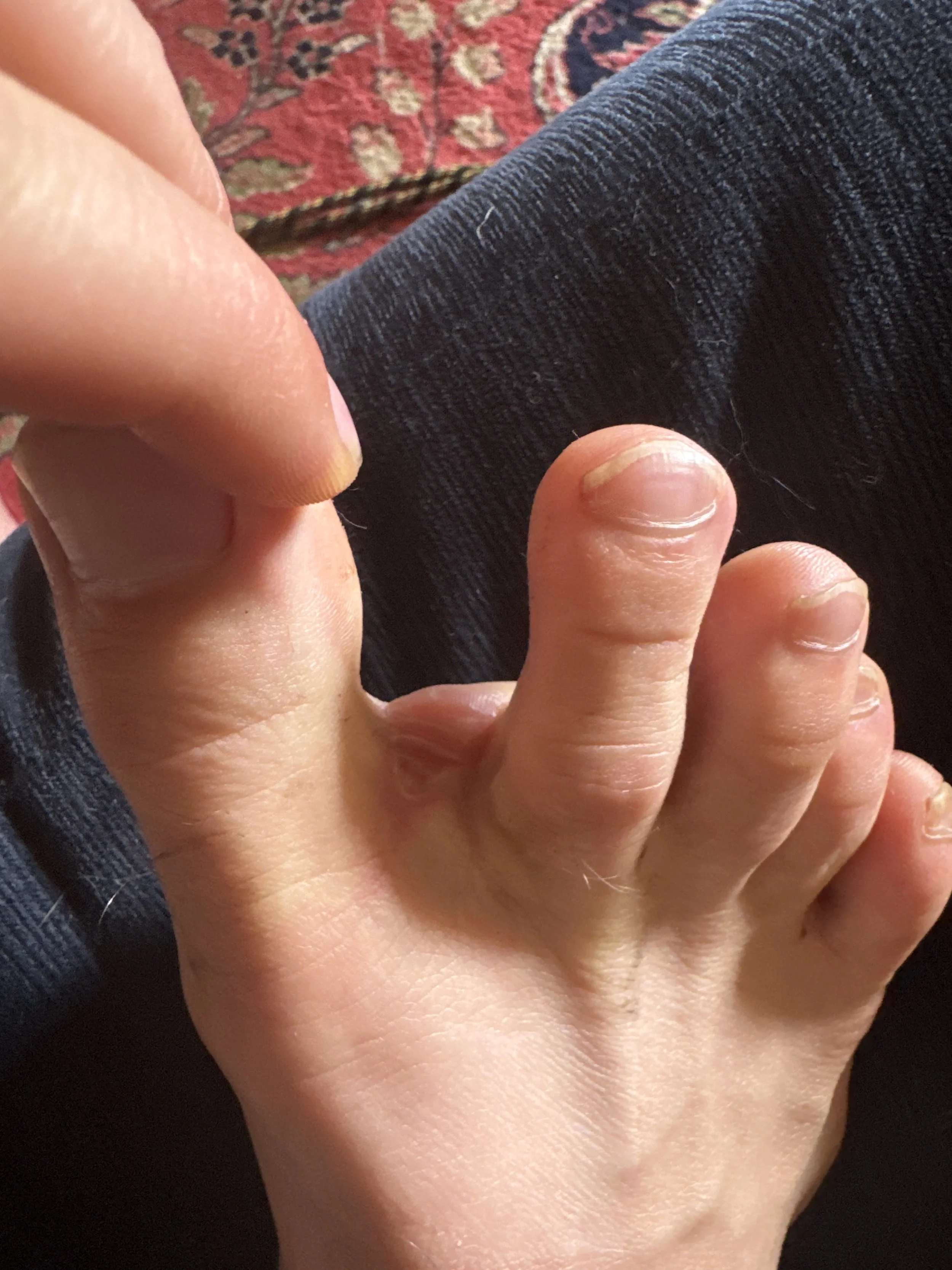 Blisters