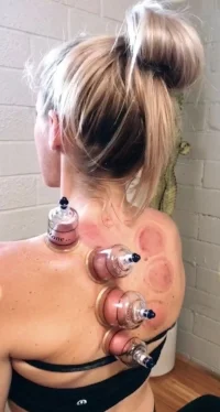 Cupping photo.jpeg