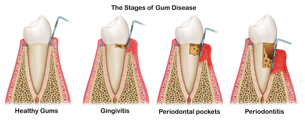 the-stages-of-gum-disease.jpg