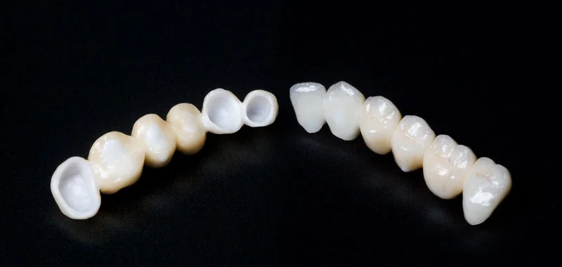 dental-bridge.jpg