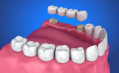 dental-bridge-burlington-dentist.jpg
