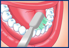 Work a 45-degree angle starting from the gum line