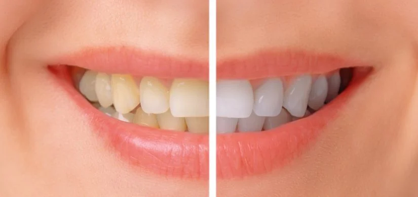 teeth-whitening-lakefront.jpg