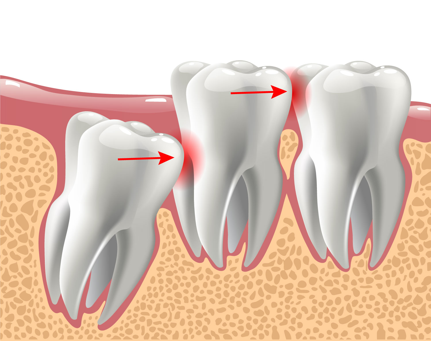 Impacted Wisdom Tooth