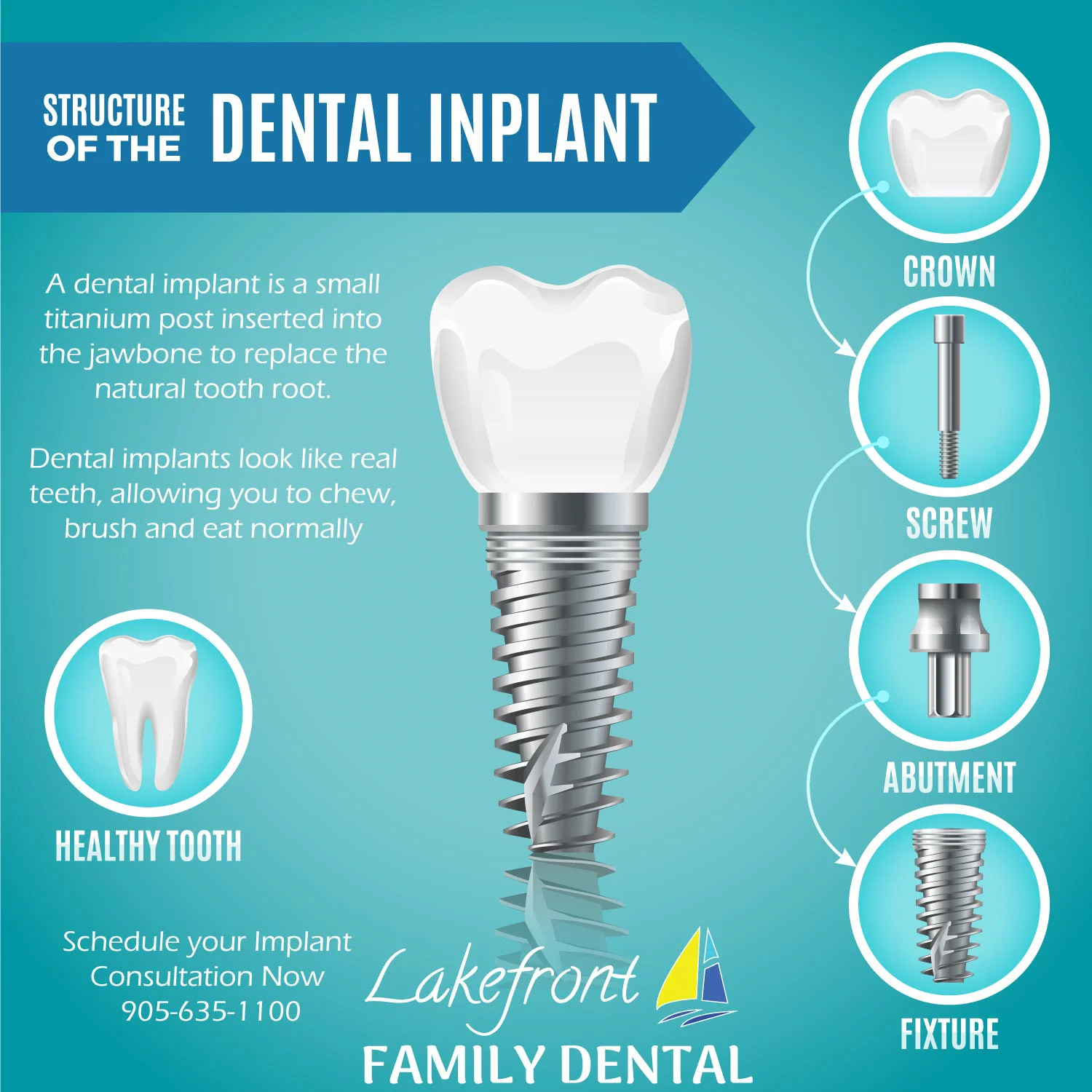 dental-implants-cost.jpg