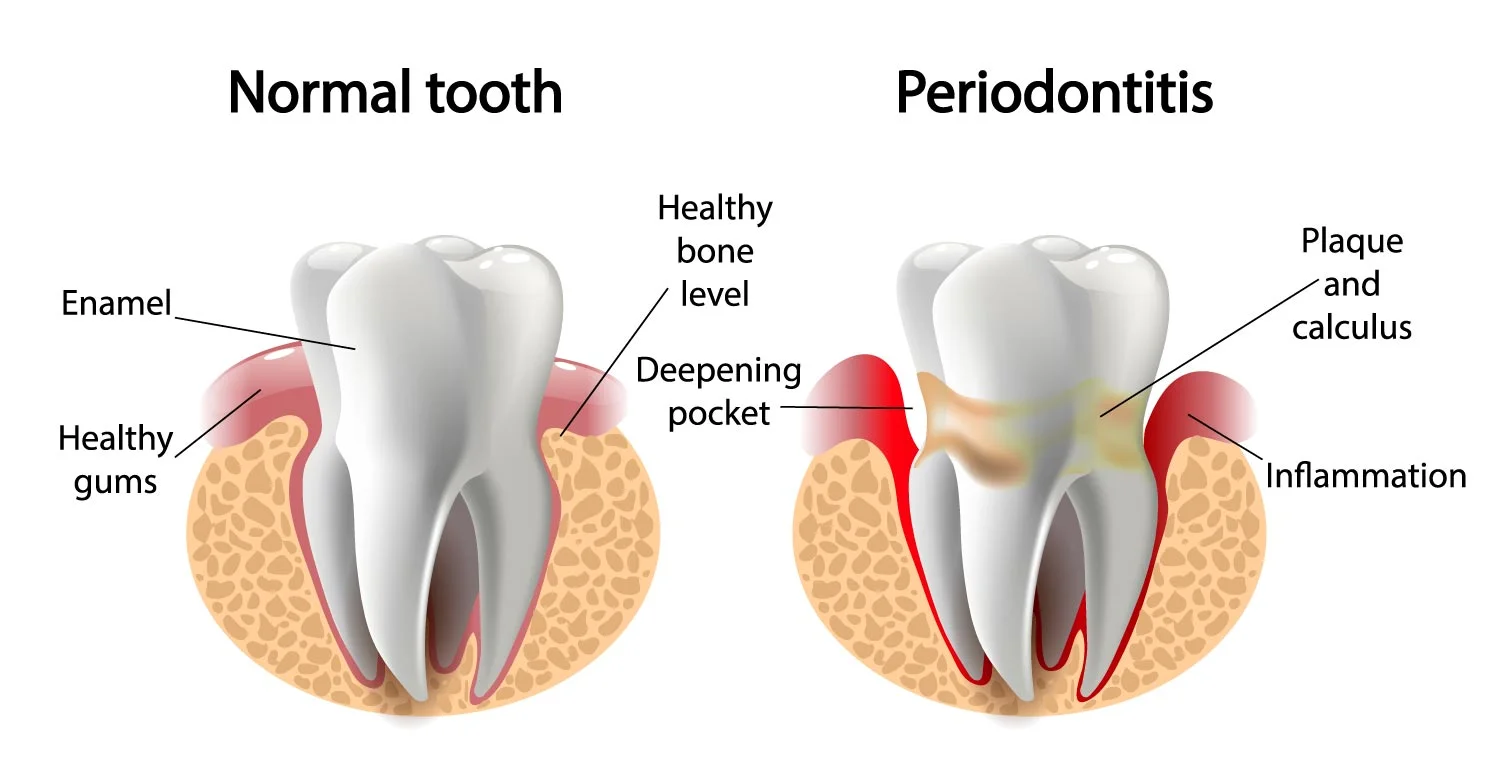 Periodontitis.jpg