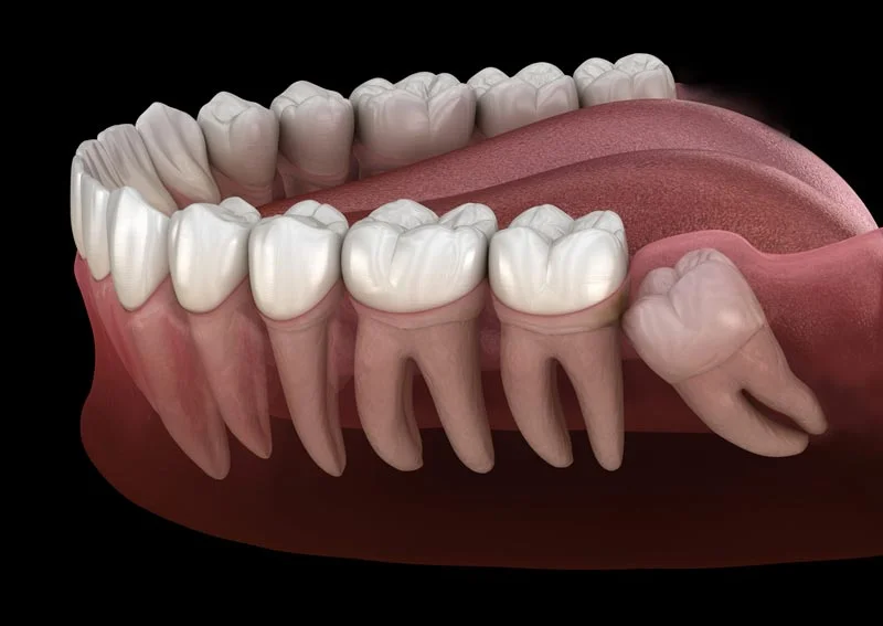 impacted-wisdom-tooth.jpg