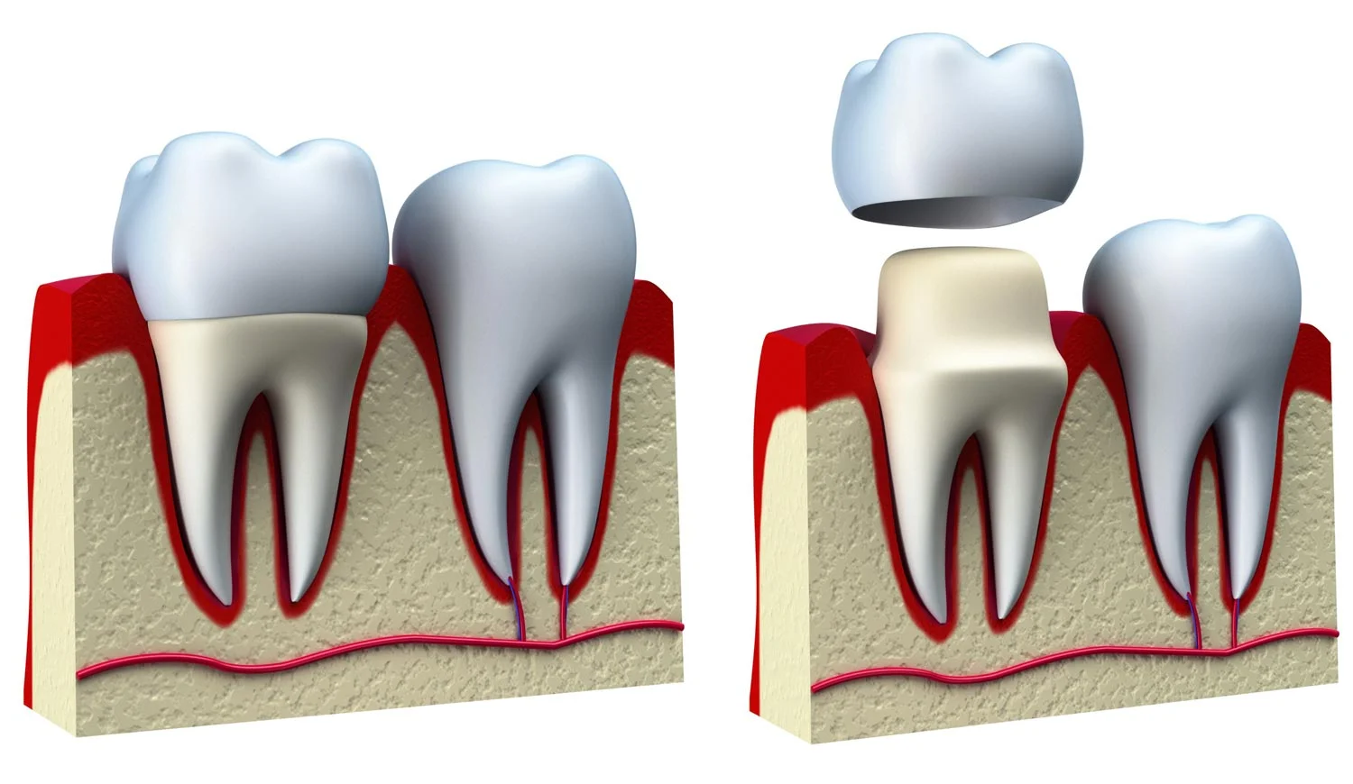 Crown dentist