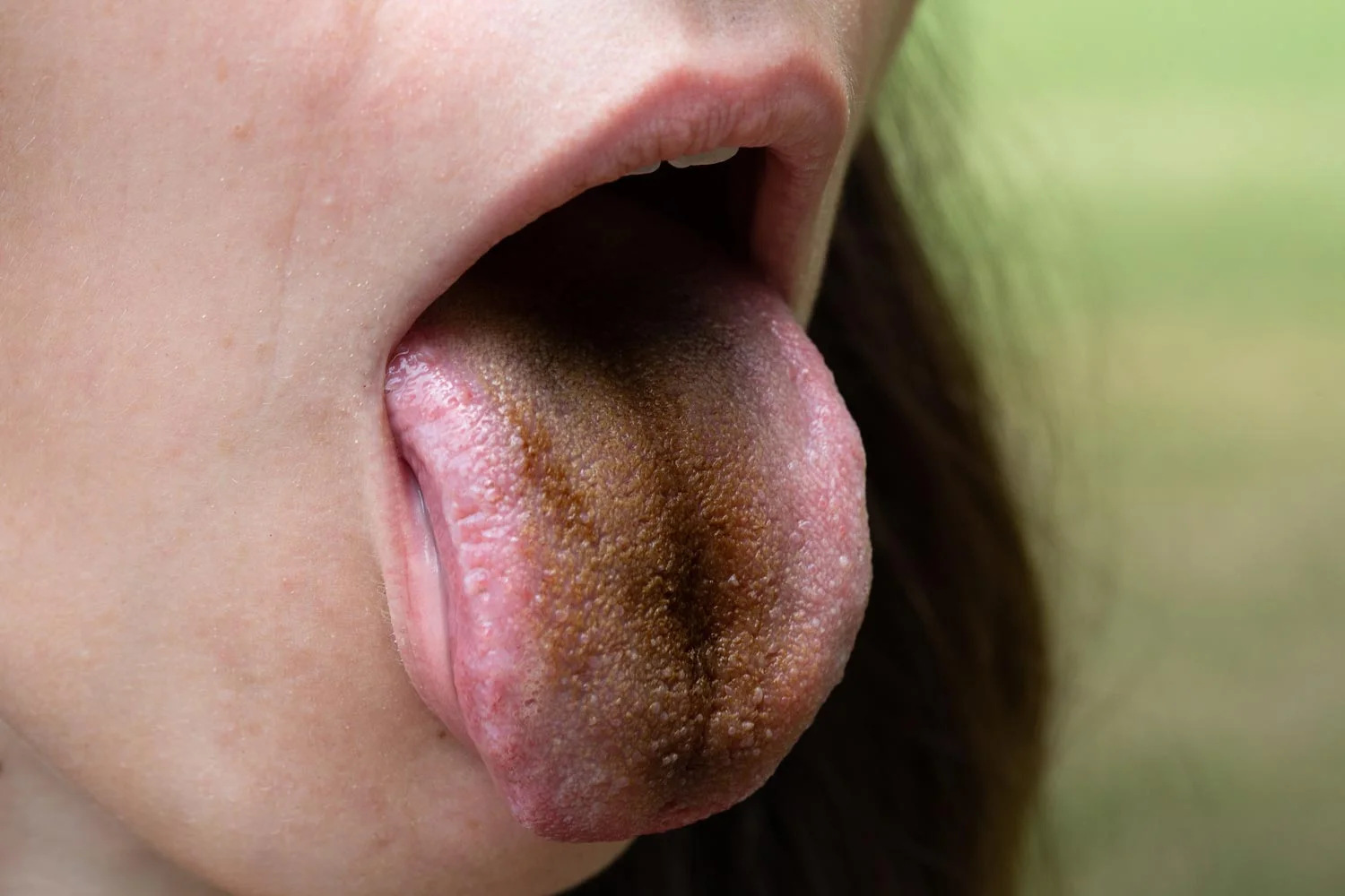 Longer papillae can retain more bacteria which will appear darker or black