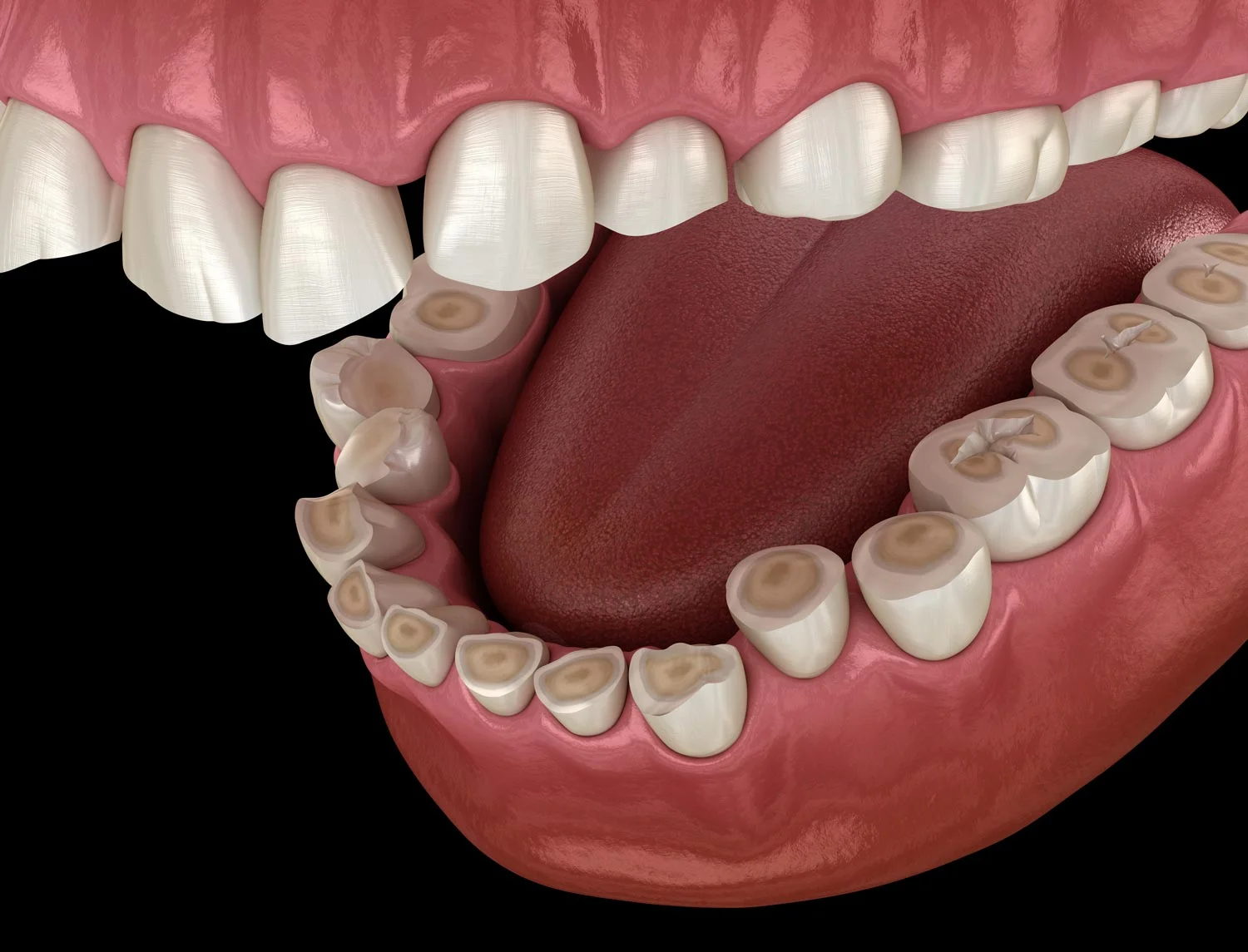 Teeth erosion