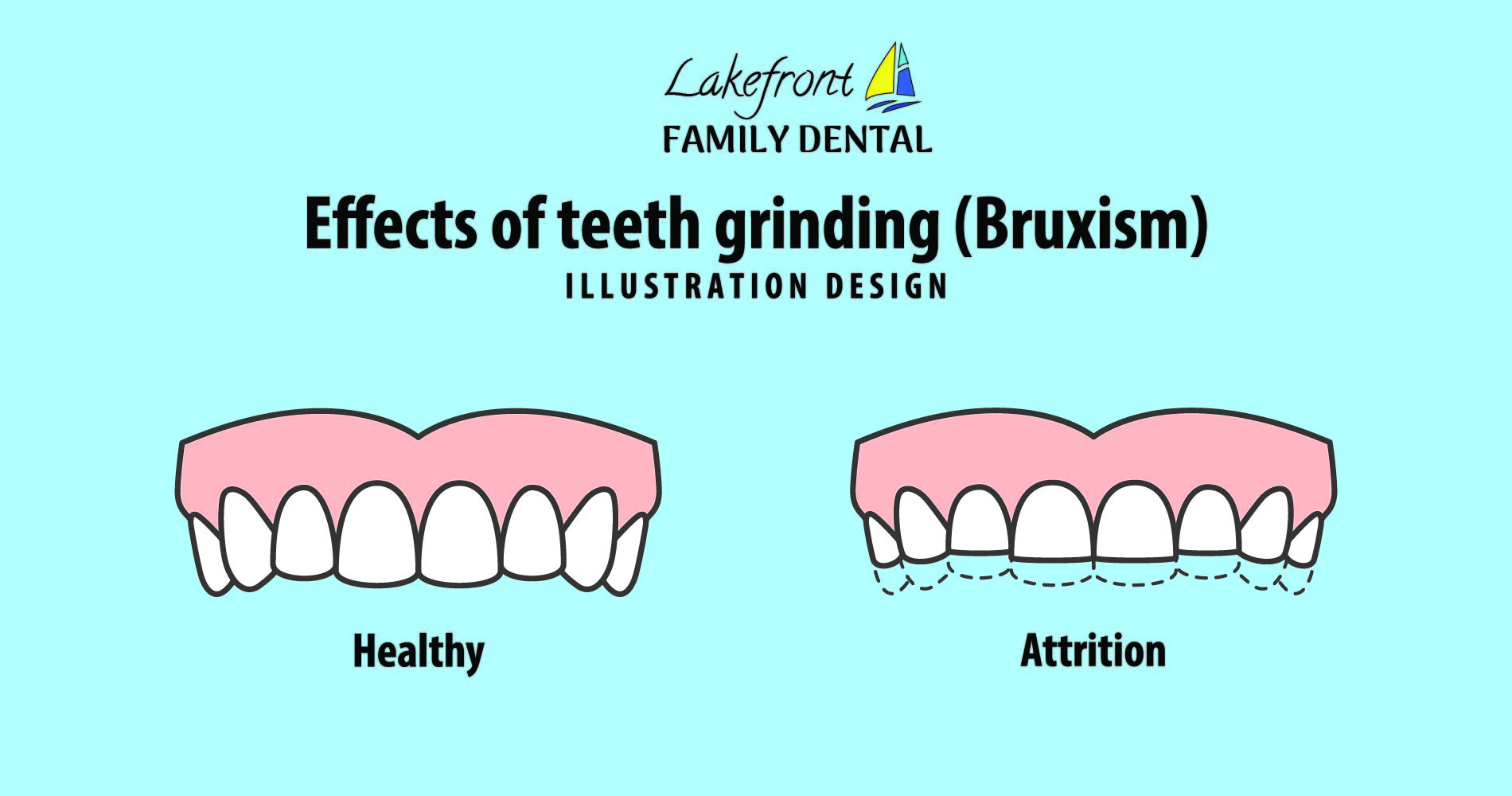 teeth grinding