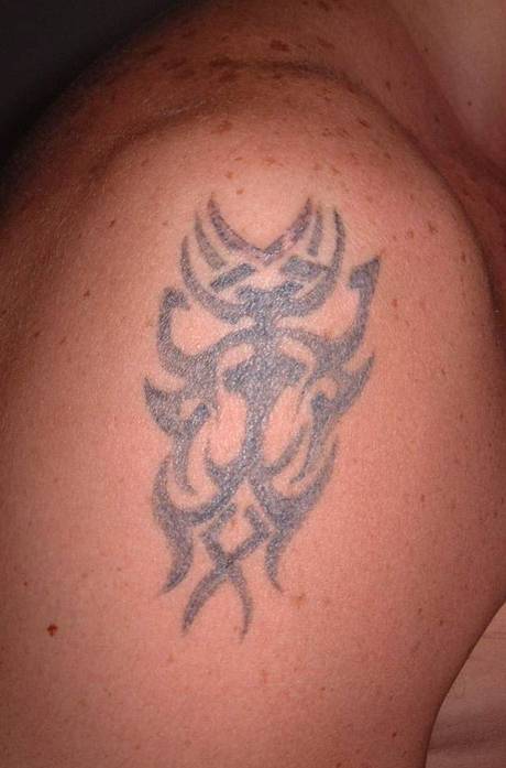 Tattoo shoulder - Pre treatment.jpg