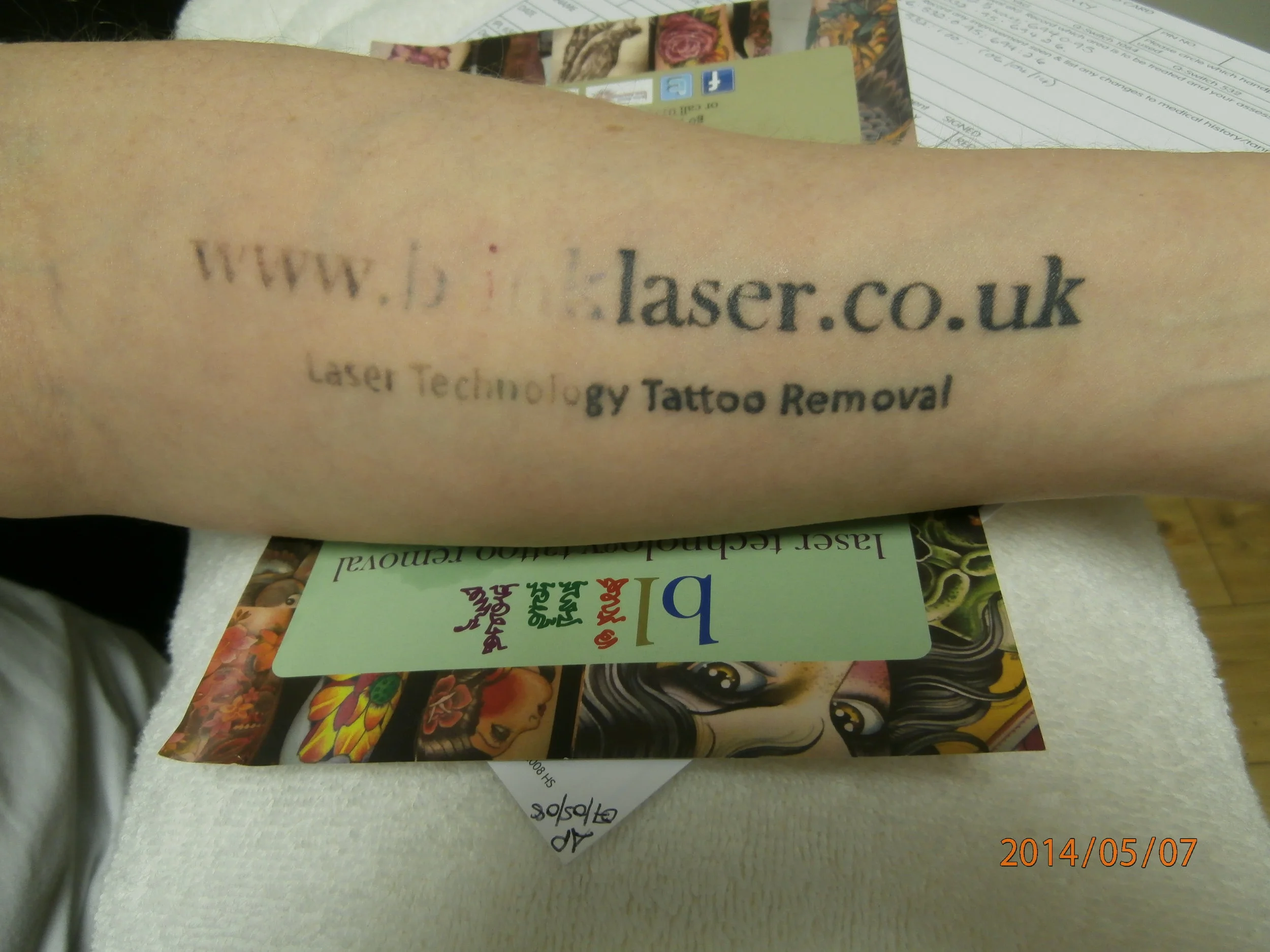 Tattoo Removal Doncaster Tatto Pictures
