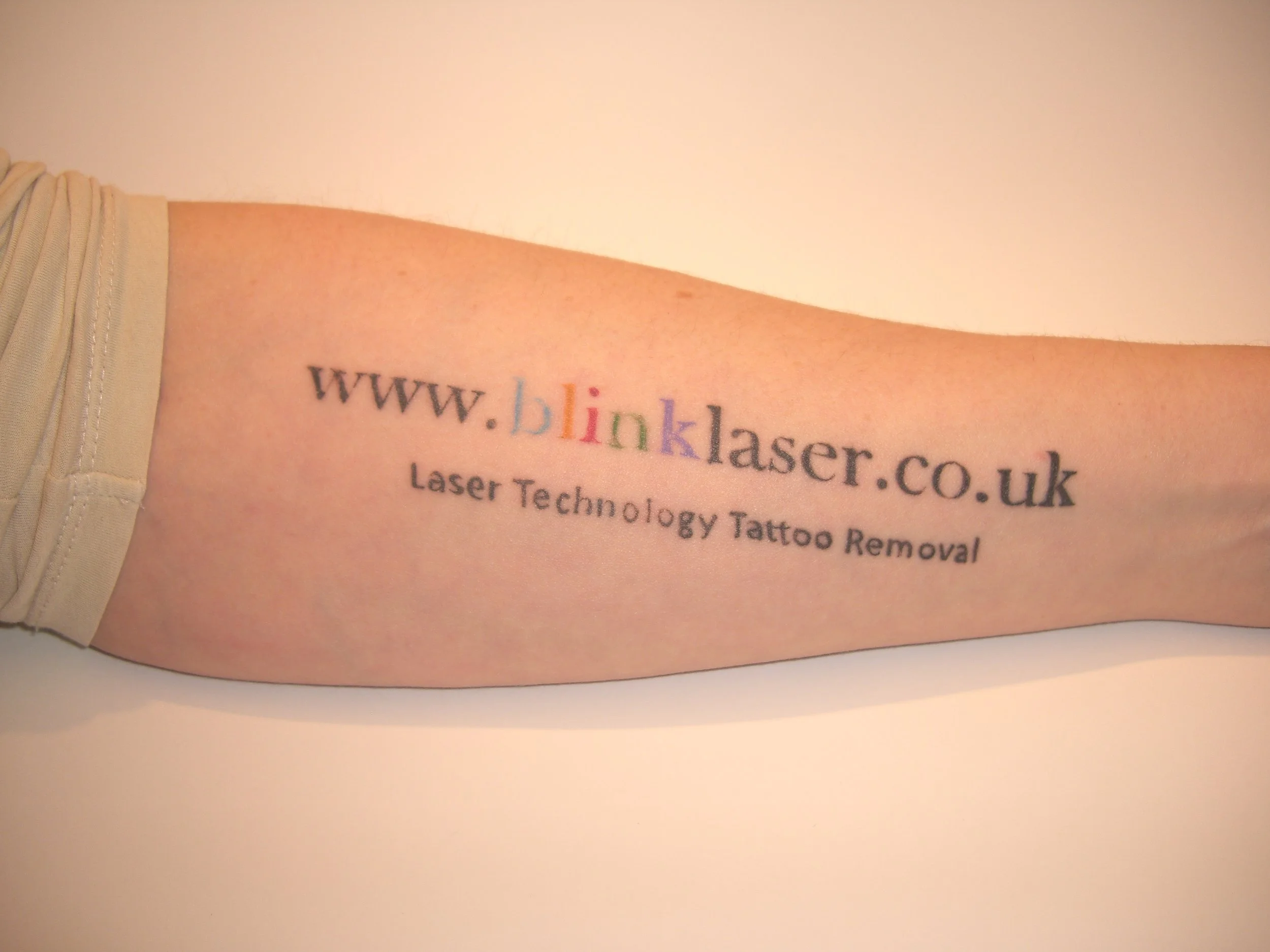 Tattoo Removal Doncaster Tatto Pictures