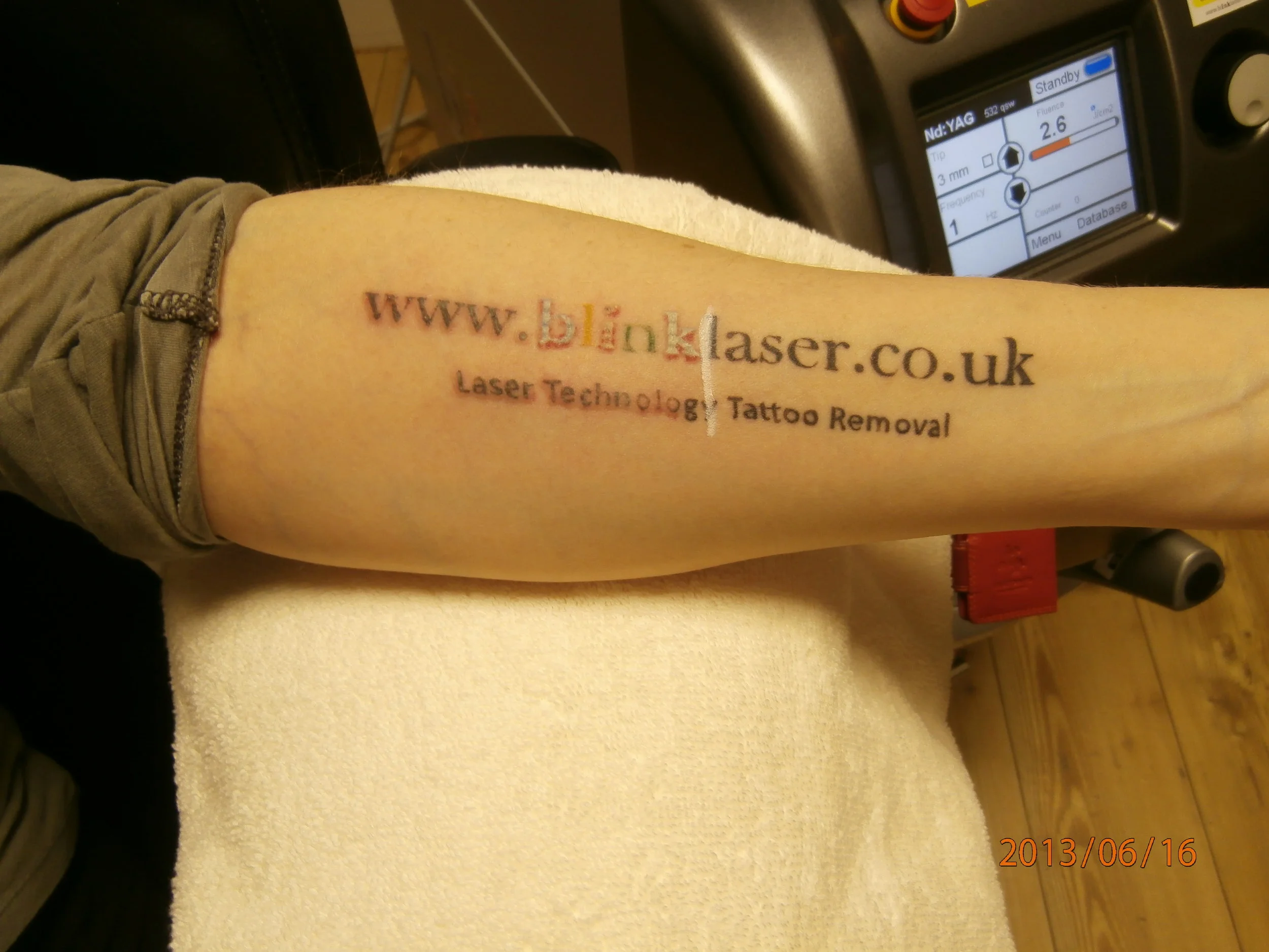 Tattoo Removal Doncaster Tatto Pictures