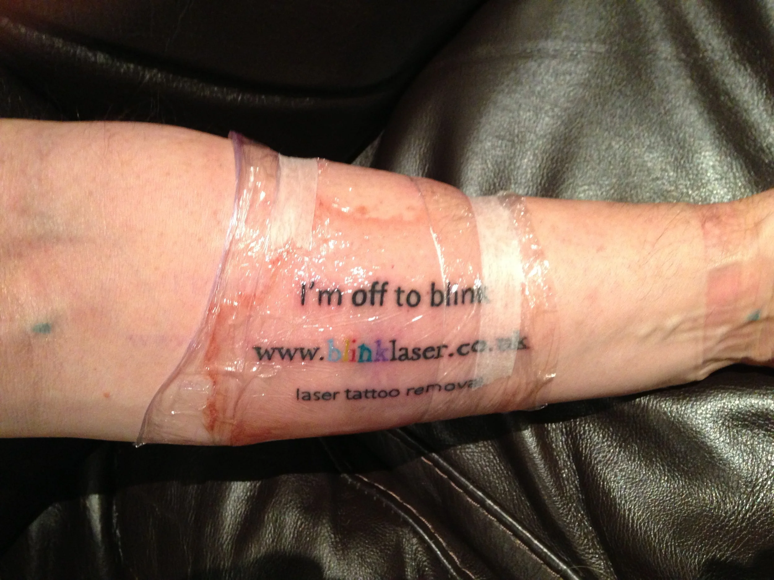 Tattoo Removal Doncaster Tatto Pictures