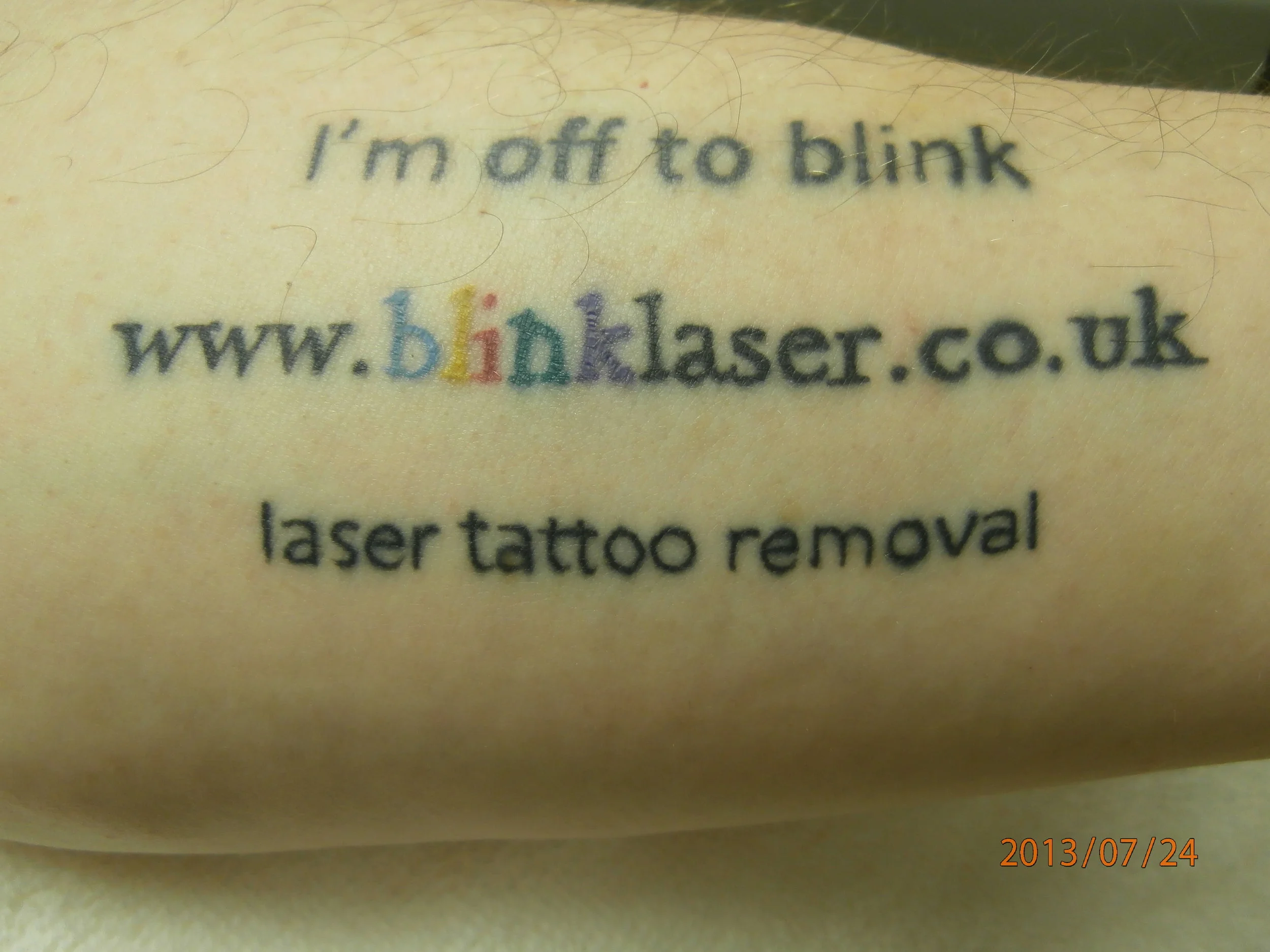 Tattoo Removal Doncaster Tatto Pictures