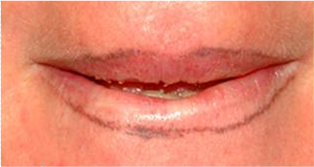 Lips after 1 session 532nm.png