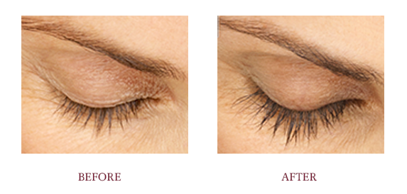 Before and After Latisse.png