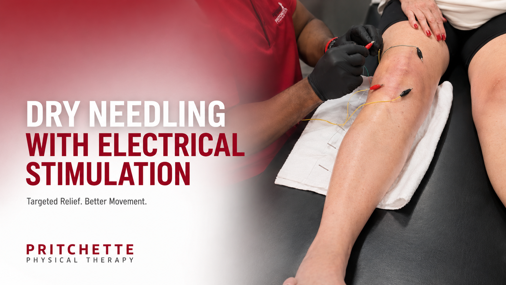 Dry Needling With Electrical Stimulation: A Powerful Combination for Pain Relief and Recovery