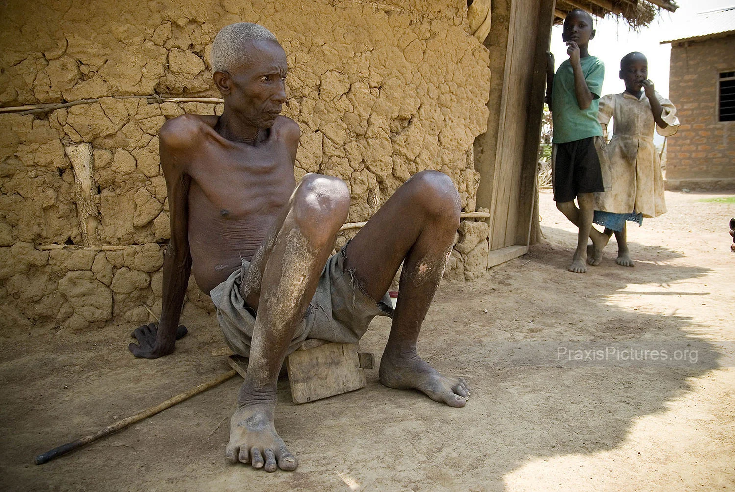 MABIBHI - Mabibhi is a resident of Nyakabale, Tanzania, a small farming community near the Geita Gold mine. He suffers from severe skin problems that first started appearing about three years ago. Residents of Nyakabale have compiled a list of 36 unusual deaths since the mine began operations in 2000, which they link to the chemicals from the mine. “The first unusual deaths,” according to one resident, “occurred shortly after the Geita mine began operating … a family of four died after eating a dying rabbit they had caught near the tailings dam. Since then, a number of women have had miscarriages.” Mabibhi is 75 years old and has lived a full life, so he says that it does not matter what happens to him — what he is really worried about is the future of his grandchildren.