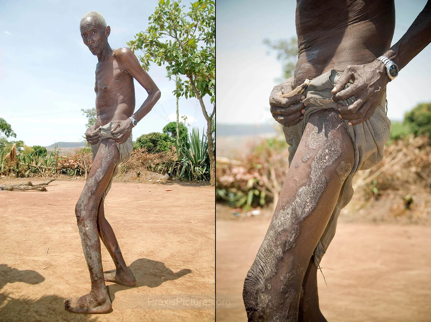 HEALTH - Research compiled by Manfred Bitala in his masters dissertation, which has been approved by the University of Dar es Salaam, has concluded that “Nyakabale Village and the immediate environment are severely polluted by heavy metals from gold mining activities of Geita Gold Mines” posing high risks to “human health, livestock and other terrestrial and aquatic life and potentially to Lake Victoria Basin at large.” Bitala calculates that the heavy metals concentration in the soil in Nyakabale is up to 6,000 times above acceptable levels set by the World Health Organization (WHO) and the Food and Agriculture Organization (FAO). Similarly the concentration in plants is 9,000 times above the acceptable level.