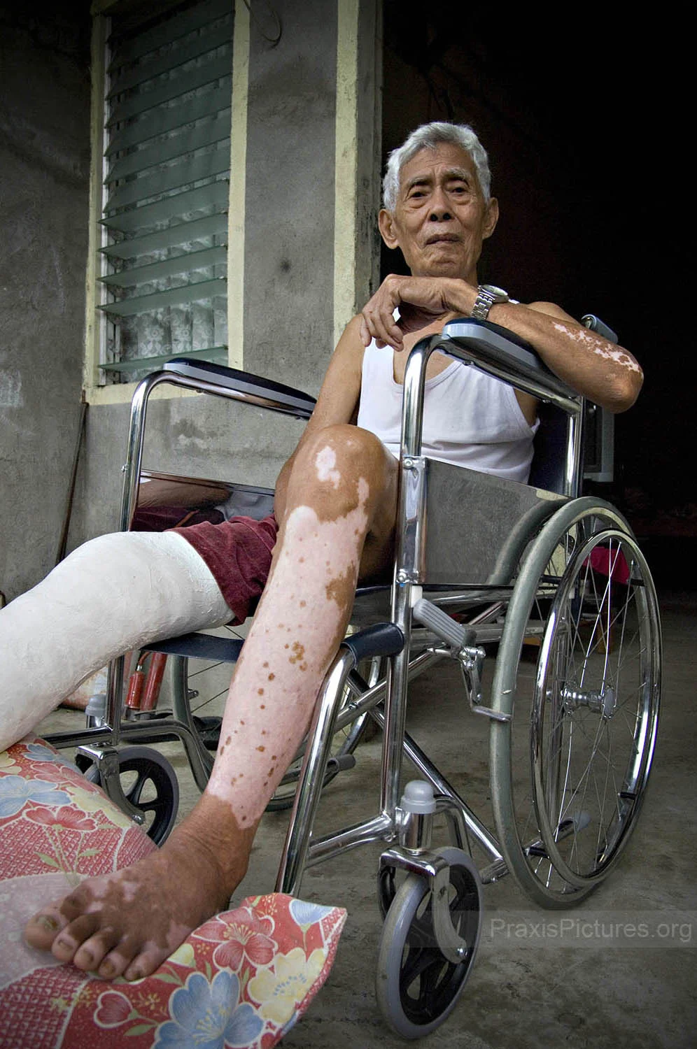 THOMAS - Eighty years old, Thomas used to bathe in the Mogpog river every day when he was younger. His body is now covered with skin discolouration which he started developing about forty years ago when Placer Dome’s mine was in full operation. Marinduque has never been able to afford conducting a full medical survey of the island, but smaller studies have shown that, of 59 children tested, every one of them had unacceptable levels of lead in their blood, and a quarter of them had dangerous levels of cyanide in their blood. Soil and air samples also showed unacceptable levels of dangerous chemicals. When Placer Dome left Marinduque, they left behind them the mess from years of dumping mine waste into Calancan Bay; the island’s two main rivers of Mogpog and Boac were poisoned by separate dam collapses in 1993 and 1996; a population suffering from heavy metal contamination; stripped forests; and a nine-hole golf course. The province never saw a single centavo of the profits that Placer Dome raked in. When the first dam collapsed in 1993, the flash flood of toxic waste swept away Thomas’ treasured cow and he nearly drowned. With the San Antonio Pit now on the verge of collapse, Thomas knows that his home will be one of the first ones swept under by the coming flash floods, but he has nowhere else go. With his already deteriorating health, he stands little chance of surviving.