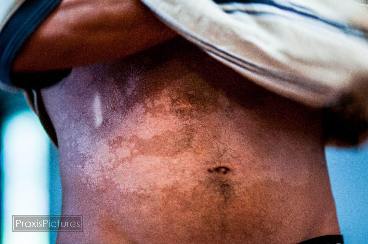 Louis Mendoza from Honduras: "One problem you can see here is skin loss, skin problems, sores. Several years ago, one of the Goldcorp reps said that this was due to the hygiene of the local population. But people also are starting to get skin coloration, these babies were born dead. If this is what people call progress, I simply don't understand."