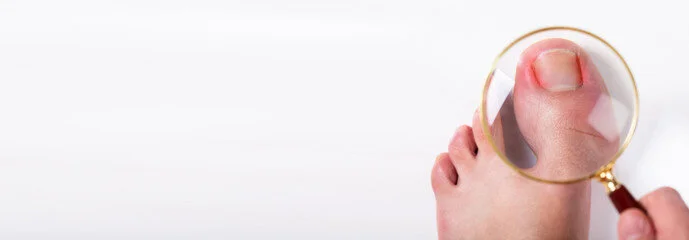 Ingrown Toenails - What they are and how we can help
