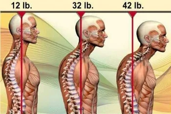 ForwardHeadPosture.jpg