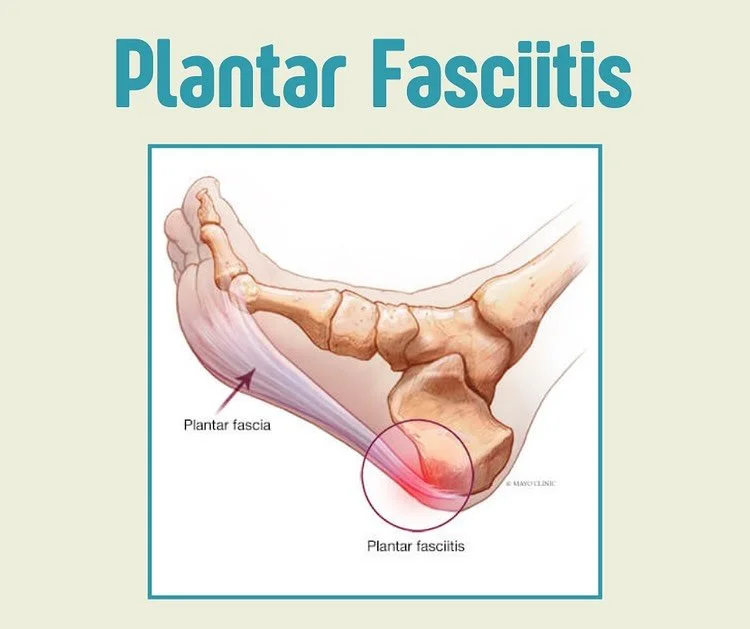 First line interventions for plantar fasciitis include stretching the foot and calf, strengthening the intrinsic muscles of the foot, wearing thick soled shoes with a wide toe box, and - you may have seen this one coming - massage!

Because the plant