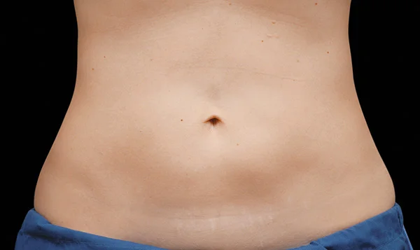 After CoolSculpting; Photos courtesy of Flor A. Mayoral, MD - individual results may vary