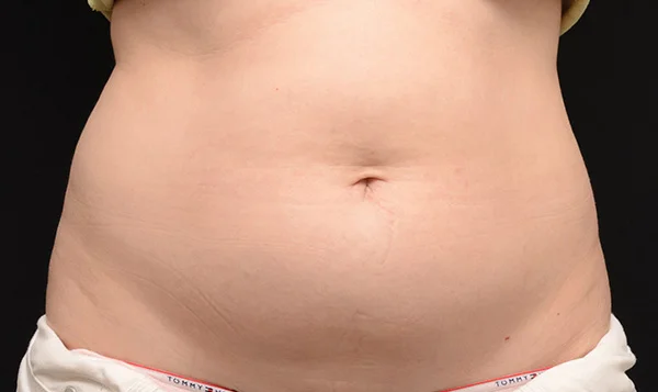 Before CoolSculpting; Photos courtesy of Edward Becker, MD