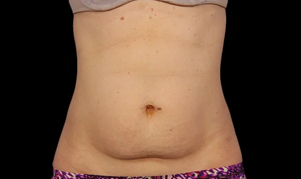 Before CoolSculpting; Photos courtesy of Grant Stevens, MD, FACS