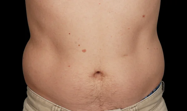 Before CoolSculpting; Photos courtesy of Barry DiBernardo, MD, FACS