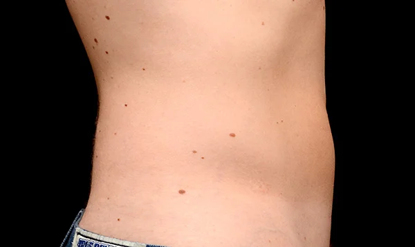 After CoolSculpting; Photos courtesy of Edward Becker, MD - individual results may vary