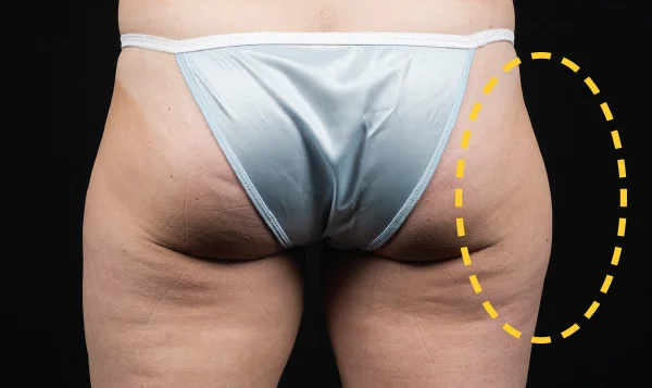 Before CoolSculpting; Photos courtesy of Eric Bachelor, MD, FACS