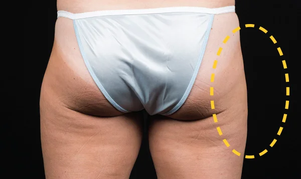 After CoolSculpting; Photos courtesy of Eric Bachelor, MD, FACS - individual results may vary
