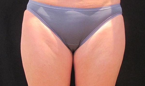 Before CoolSculpting; Photo courtesy of Tracy Mountford, MD