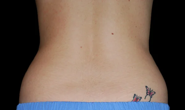 After CoolSculpting; Photos courtesy of Ron Shelton, MD - individual results may vary